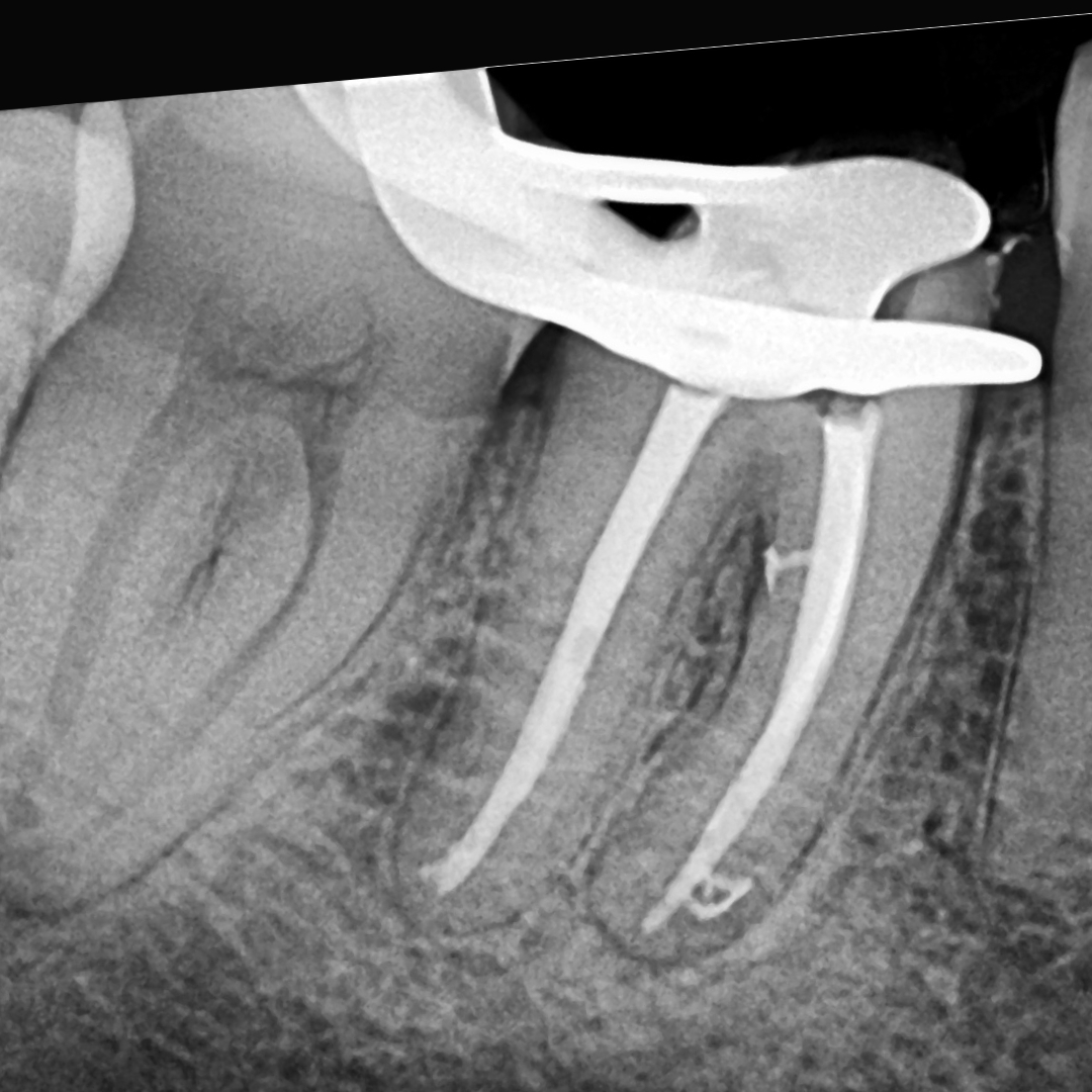 Después Caso 3